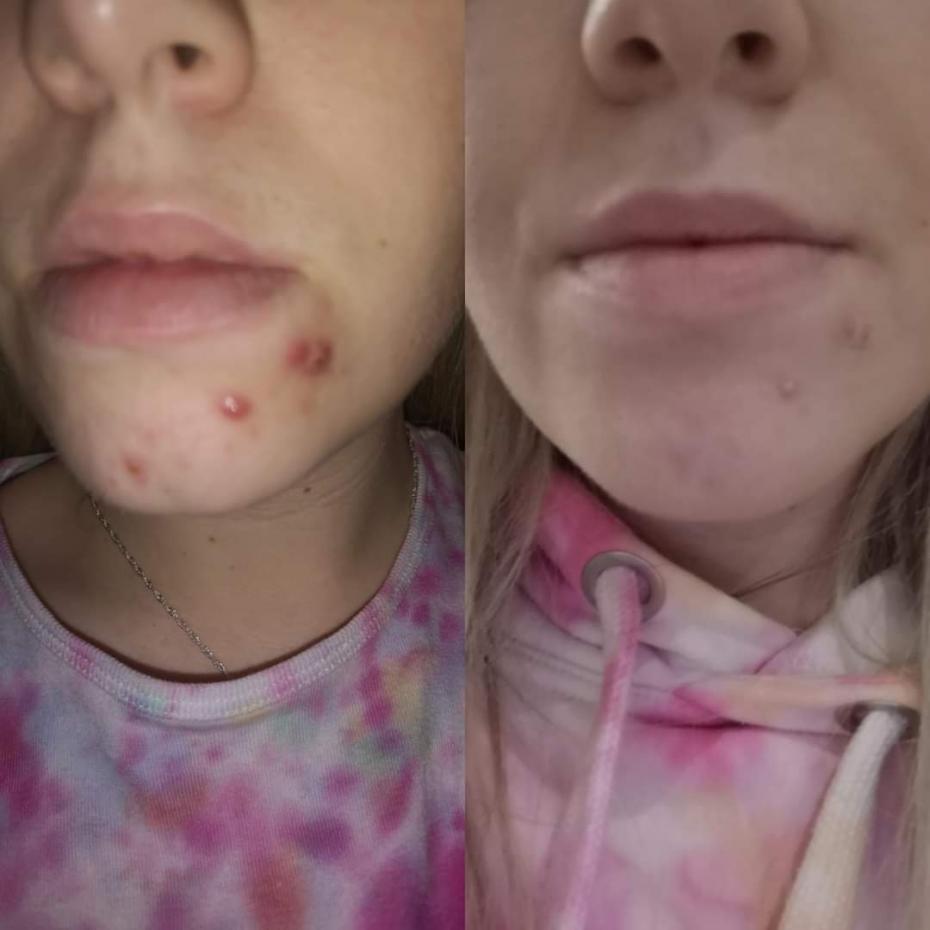 (Hormonal Acne) a 24 hour difference  after applying NovaPure Naturals Multipurpose Powder  just twice.